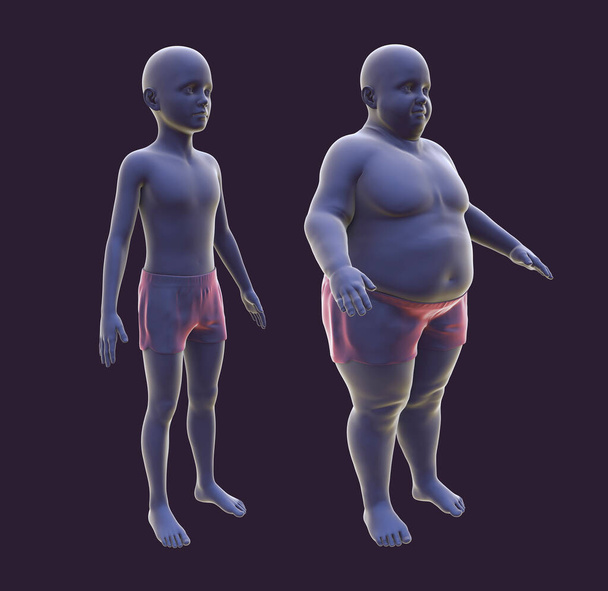 Obese boy before and after gaining weight, 3D illustration. Concept of obesity, behavioral problem, psychiatric condition, binge eating disorder, food addiction - Photo, Image