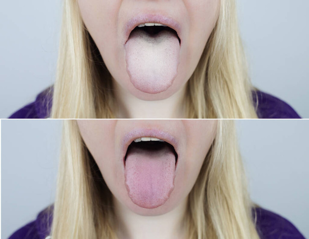 A mulher tem uma língua branca. Revestimento branco doloroso na membrana mucosa da língua. Doenças do trato gastrointestinal, fígado e vesícula biliar. Consequências da toma de antibióticos. - Foto, Imagem