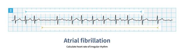 Atrial fibrillation is a kind of atrial tachyarrhythmia, and the ventricular rate is absolutely irregular.You can calculate the mean cardiac cycle of 10 heartbeats. - Fotoğraf, Görsel