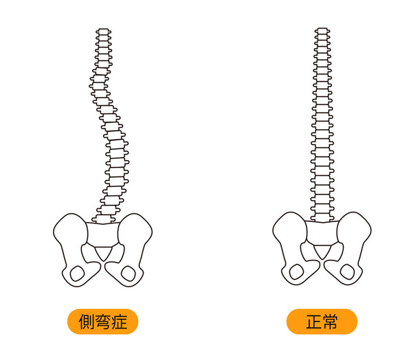 Postawa medyczna (skolioza) Bone Upper body Powrót Ilustracja - Wektor, obraz