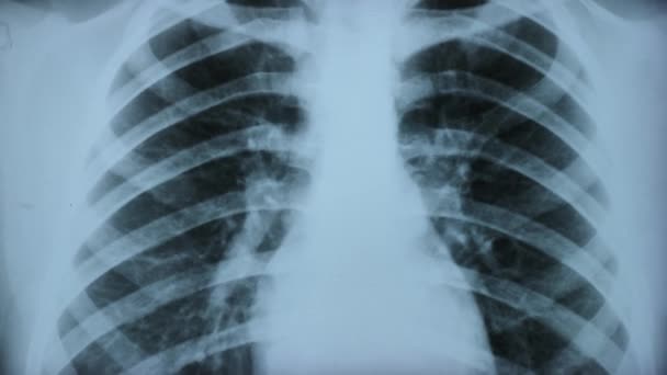 Röntgenuntersuchung der LUNGENNORM und PATHOLOGIE. In der Abbildung der Brust von Lungenanomalien sind Bereiche hoher oder niedriger Dichte manifestiert. Nahaufnahme - Filmmaterial, Video