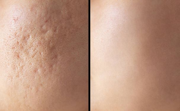 Skin human texture background. Closeup before and after spot red scar acne pimple treatment on skin face asian woman. Problem skincare and beauty concept. - Photo, image