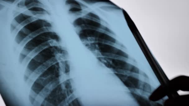 NORMAL AND PATHOLOGICAL LUNG X-RAY. X-RAY scan of the chest of the lungs reveals abnormalities, areas of increased or low density, diagnosis of pneumonia, coronavirus Close up - Záběry, video