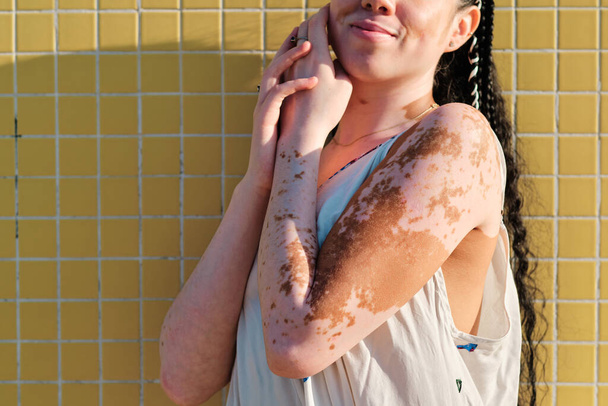 Close-up view of a woman with vitiligo posing outdoors with natural light. - Fotoğraf, Görsel