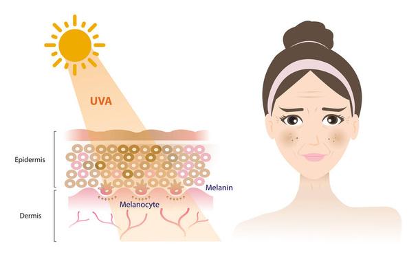 Οι ακτίνες UVA διεισδύουν στο δερματικό στρώμα του δέρματος, βλάπτουν το πρόσωπο της γυναίκας, με αποτέλεσμα το μαύρισμα, το μελάνωμα, τη γήρανση, τις ρυτίδες, τις σκούρες κηλίδες να απομονώνονται σε λευκό φόντο. Εικονογράφηση έννοια φροντίδας του δέρματος. - Διάνυσμα, εικόνα