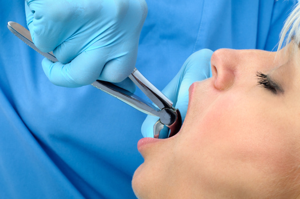 Extração dentária - Foto, Imagem
