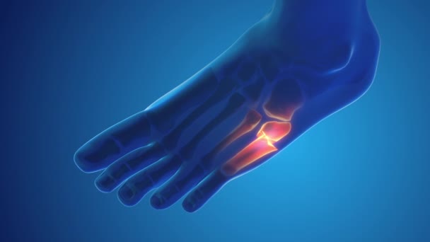 Fracture pied douleur osseuse concept médical - Séquence, vidéo