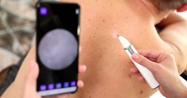 Method of dermatoscopy of skin formations and moles. Melanoma and skin cancer prevention and skin screening - Filmagem, Vídeo