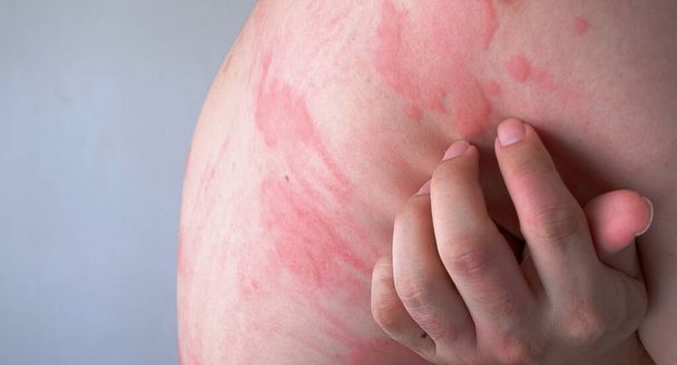 Zbliżenie obrazu tekstury skóry cierpiącej na ciężką pokrzywkę lub pokrzywkę lub kaligata na plecach. Objawy alergii. - Zdjęcie, obraz