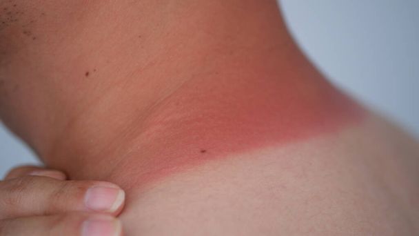 redness on the man neck of sunburn, close-up view - Fotoğraf, Görsel