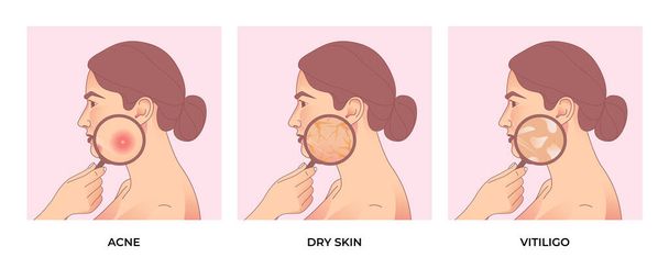 donne faccia con diversi tipi di diversi tipi di problemi della pelle, acne, brufoli, pori della pelle, pelle secca e vitiligine. concetto di cura della pelle. - Vettoriali, immagini