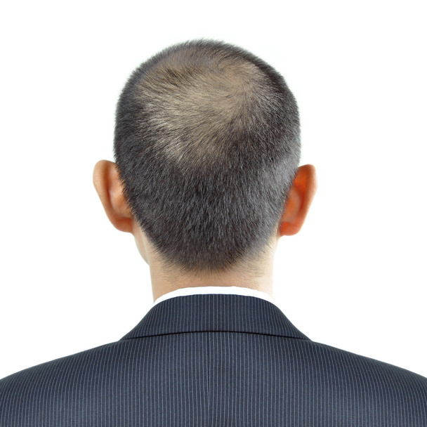 Belirti bir adam kafasına - işareti saç dökülmesi inceltme saç - Fotoğraf, Görsel