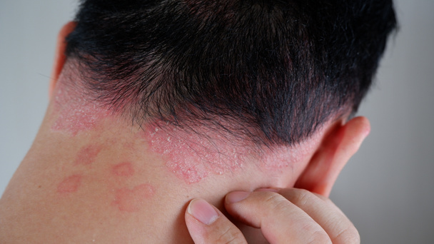 Close-up view of psoriasis on the man nape, skin with psoriasis - Photo, image