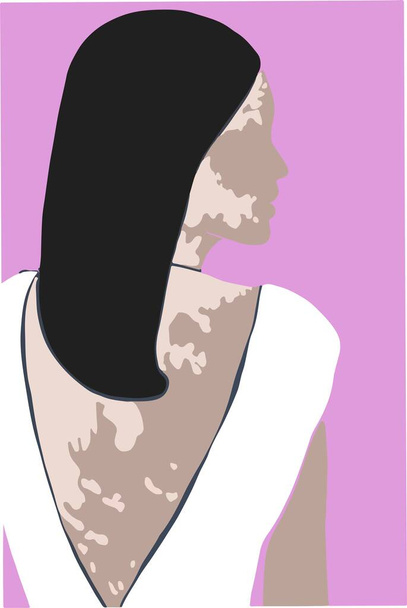 vector illustration of a beautiful Vitiligo woman in half turn, unique skin, natural beauty concept - Vettoriali, immagini