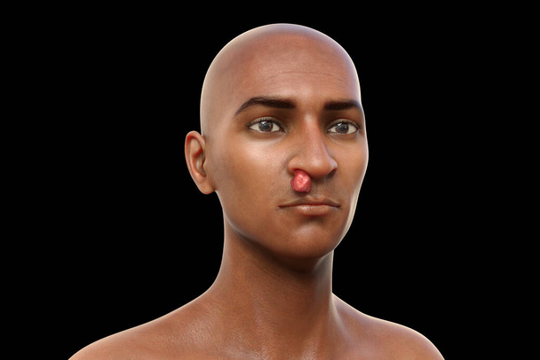 Носовой риноспоридиоз у пациента, 3D иллюстрация. Заболевание, вызванное паразитом Rhinosporidium seeberi и приводящее к образованию полипоидальных масс в носоглотке и конъюнктиве - Фото, изображение