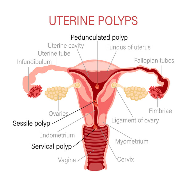 Types of uterine polyps. Diseases of the female reproductive system. Gynecology. Medical concept. Infographic banner. Vector - Vektor, kép