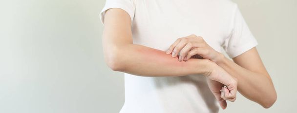 persona tiene sarpullido rojo en el brazo por picadura de insecto alérgico. - Foto, Imagen