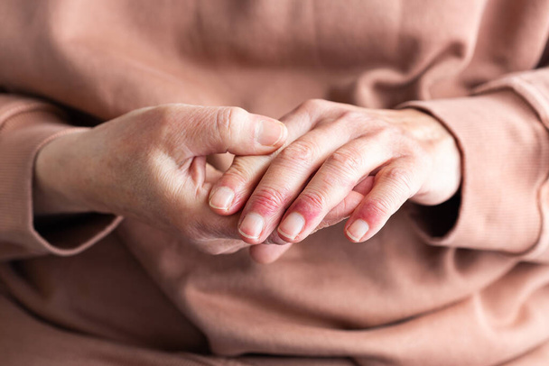 Закрыть руки пожилой женщины с атопическим дерматитом, экземой, аллергической реакцией на сухую кожу - Фото, изображение