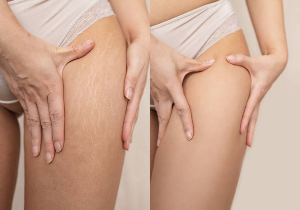 Порівняння зображень до і після жіночих ніг з видаленням розтяжок, реальними людьми. Концепція догляду за шкірою
. - Фото, зображення