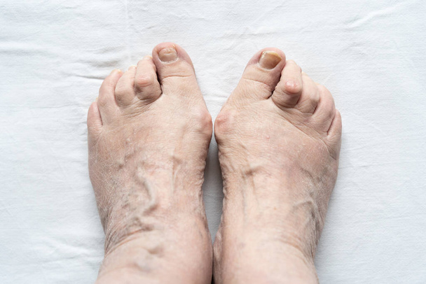 Horní pohled na ženské nohy spolu s kladivem palce, zlomené nehty a suché kůže na bílém pozadí. Hygiena, lékařství, zdravotní péče, podiatrista, dermatologie pojmy - Fotografie, Obrázek