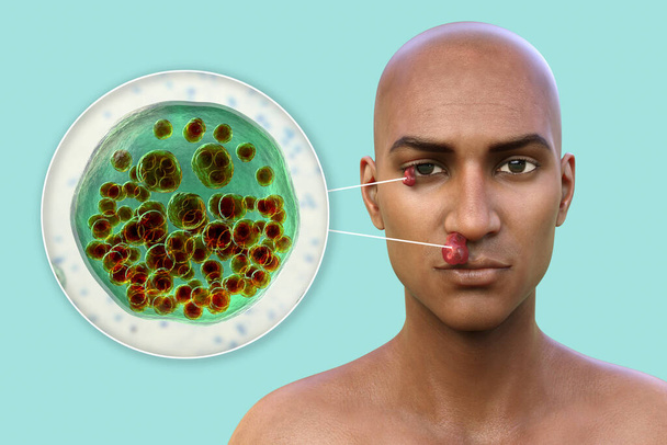 Orr és szem rhinosporidiosis egy beteg, 3D illusztráció. A betegség által okozott rhinosporidium seeberi parazita, vezet kialakulásához polypoidal tömegek nasopharynx és kötőhártya - Fotó, kép