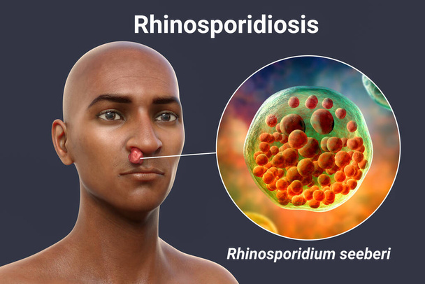 Nasal rhinosporidiosis in a patient, 3D illustration. A disease caused by Rhinosporidium seeberi parasite, leads to formation of polypoidal masses in nasopharynx and conjunctiva - Photo, Image