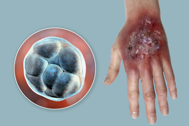 Protothecose-Infektion an der menschlichen Hand und Nahaufnahme von Prototheca wickerhamii Grünalgen, dem Erreger der Krankheit, 3D-Illustration - Foto, Bild
