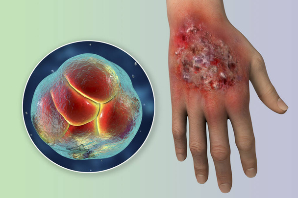 Protothecose-Infektion an der menschlichen Hand und Nahaufnahme von Prototheca wickerhamii Grünalgen, dem Erreger der Krankheit, 3D-Illustration - Foto, Bild