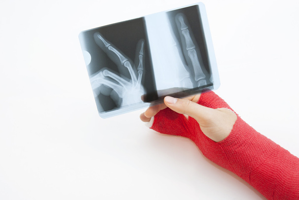 bandagierte Hand und Röntgenbild - Foto, Bild