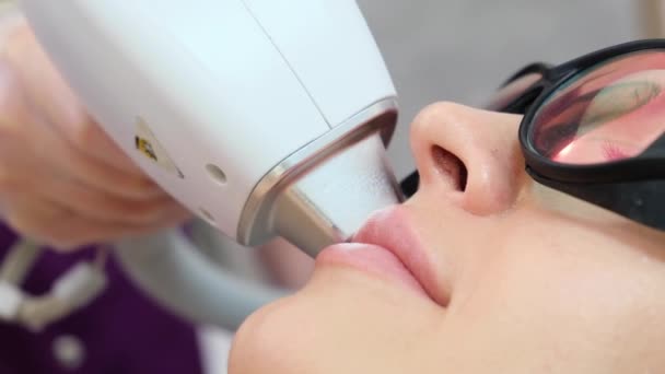 Epilazione laser del viso. Rimozione dei peli nella zona sopra le labbra. - Filmati, video
