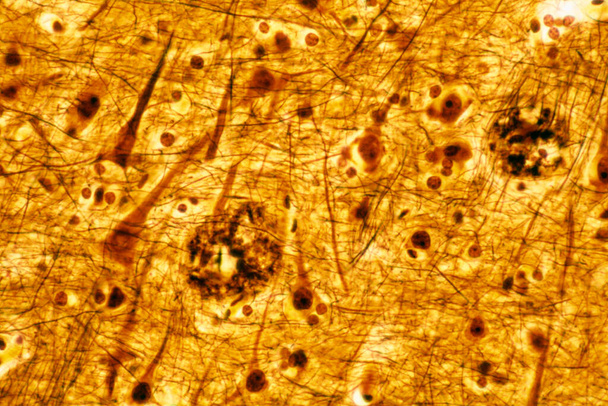 Μικρογραφία μικροσκοπίου ενός ανθρώπινου εγκεφαλικού φλοιού που δείχνει δύο γεροντικές πλάκες, χρωματισμένες με ασημένια μέθοδο. Πρόκειται για εξωκυτταρικά κοιτάσματα αμυλοειδούς βήτα που εμφανίζονται σε μεγάλους αριθμούς στη νόσο του Αλτσχάιμερ.. - Φωτογραφία, εικόνα