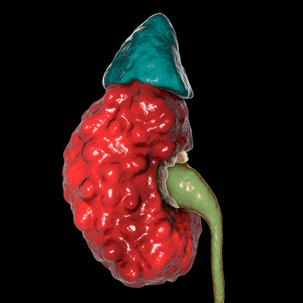 慢性腎炎,特に極と拡張尿管で不規則な傷んだ皮質表面を示す3Dイラスト - 写真・画像