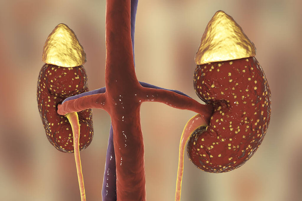 Pielonefritis, concepto médico, ilustración 3D que muestra la presencia de ampollas purulentas en el tejido renal - Foto, imagen