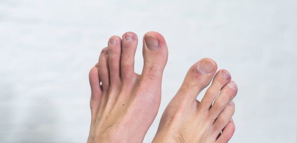 A mans toes showing what looks like a rash with red blotchy skin. A common side effect of Covid-19 often referred to as Covid toe - Zdjęcie, obraz
