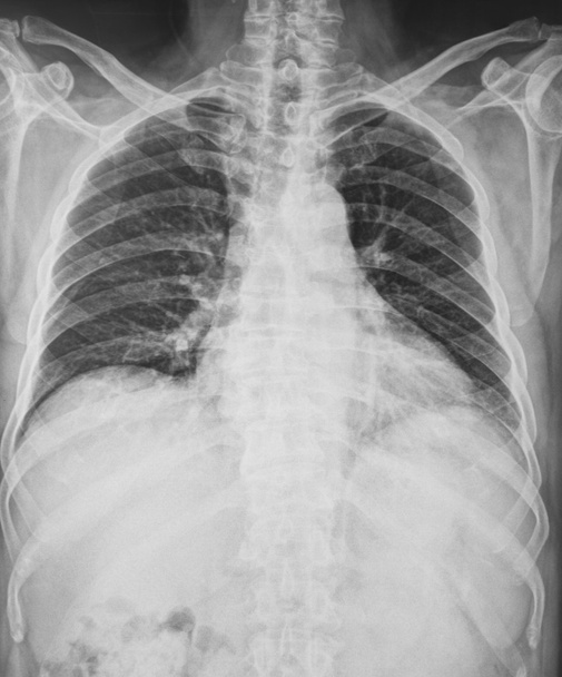 X-Ray Afbeelding van de menselijke borst - Foto, afbeelding