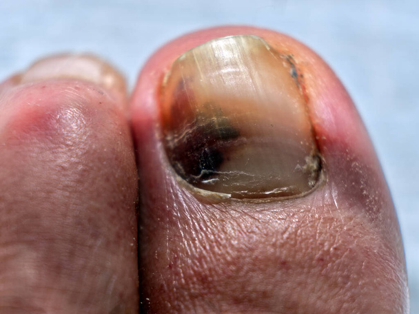 Subungual hematoma in a big toe. High quality photo - Foto, afbeelding