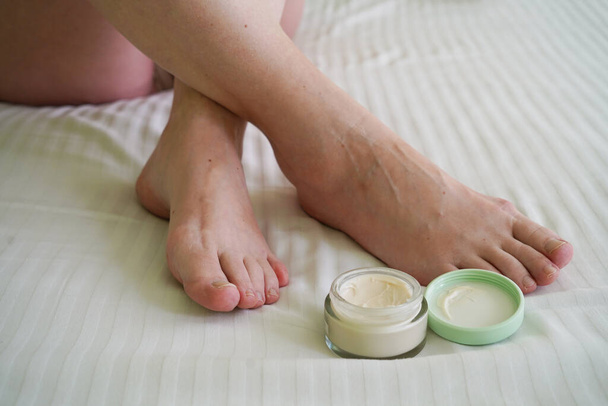 female legs with problem with women's feet and cream cosmetic, bunion toes in bare feet. Hallus valgus, closeup - Photo, Image