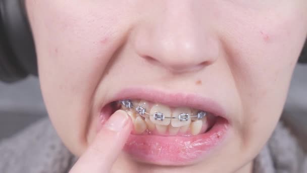 Kız parmağıyla metal tellerine dokunuyor. Diş telleriyle ağzını kapat. Ortodonti tedavisi. - Video, Çekim