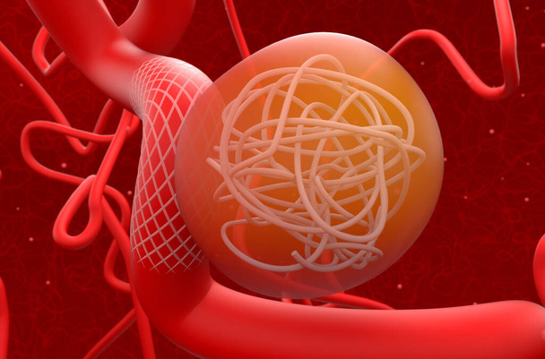 Aneurysm treat with mesh stent and coils - 3d illustration closeup view - Photo, Image