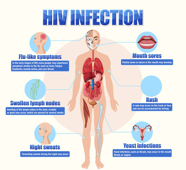 Informatives Plakat der HIV-Infektion Illustration - Vektor, Bild