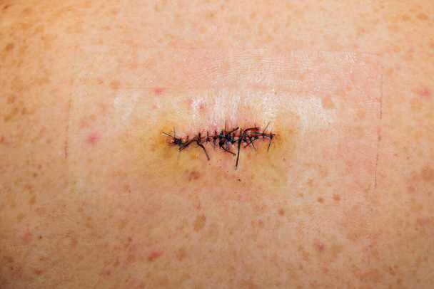 Kaksoisommeltu arpi paise leikkaus selässä - Valokuva, kuva