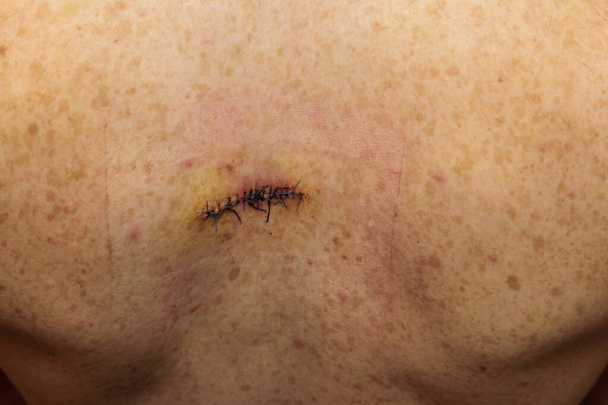 Dubbele hechting litteken van abces chirurgie op een rug - Foto, afbeelding