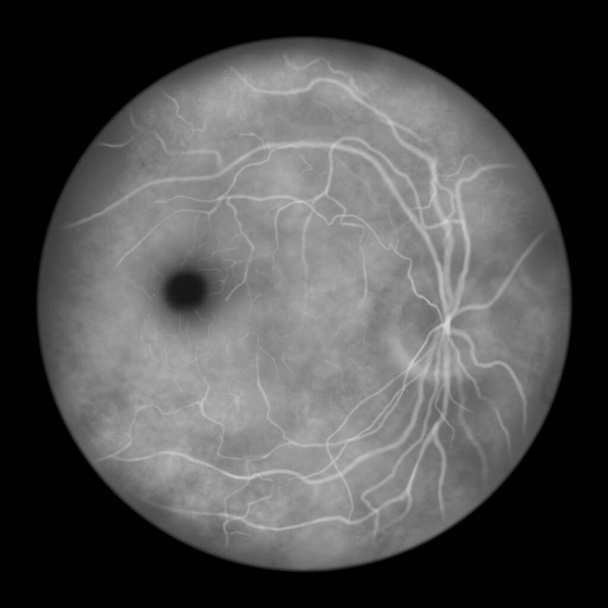 Paras vitelliforminen makulaarinen dystrofia, vaiheen 2 vitelliformi, klassinen munankeltuaisvaurio, tieteellinen kuva, oftalmoskooppinäkymä, fluoreseiiniangiografia - Valokuva, kuva