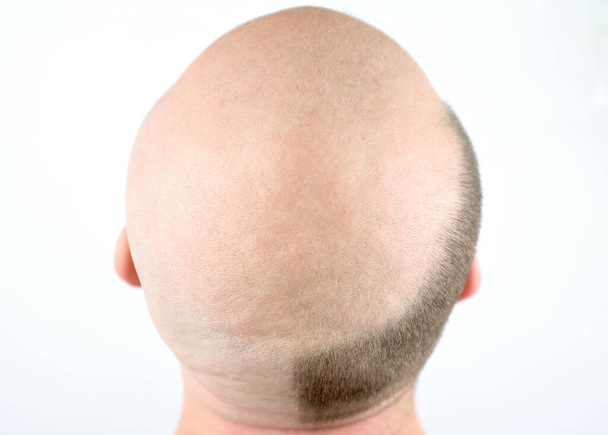 Bald man, rear view. Baldness close-up. Loss of hair on the head. Bald head. Hair transplantation, care and treatment. Severe baldness. Half-shaved head. An unshaven man - Zdjęcie, obraz