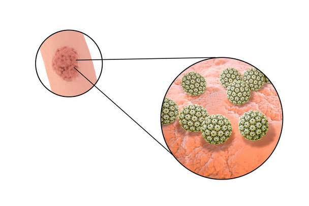 Erkeklerde Papillomavirus HPV lezyonları, genital siğiller ve HPV 'nin yakın plan görüntüsü. 3B illüstrasyon - Fotoğraf, Görsel