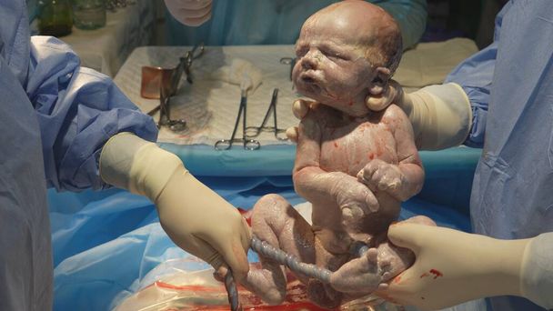 The doctor removes the baby from the mother's abdomen and cuts the umbilical cord. The process of cutting the umbilical cord of a newborn baby close-up. Childbirth by caesarean section. - Photo, Image