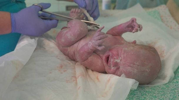 Een verpleegster snijdt de navelstreng van een pasgeboren baby door. Klem de navelstreng van de pasgeborene vast. pasgeboren baby. - Foto, afbeelding