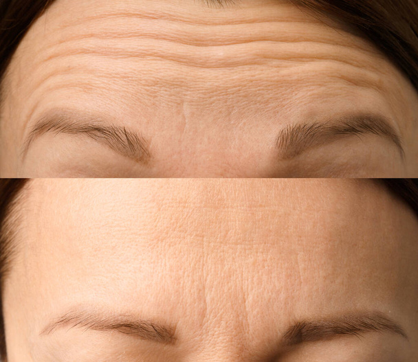 Arrugas de cerca. Tratamientos faciales. Programa anti-envejecimiento, concepto. Eliminación de arrugas, cambios relacionados con la edad. Cosmetología, inyecciones, mesoterapia. - Foto, Imagen