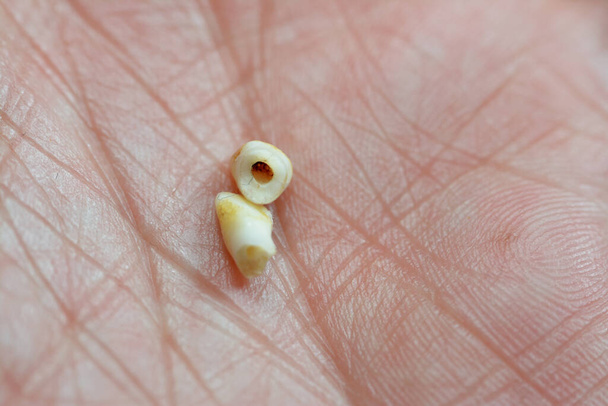 Φυλλοβόλα πρωτογενή προσωρινά δόντια του μωρού, το πρώτο σύνολο των δοντιών στην ανάπτυξη και την ανάπτυξη των ανθρώπων, Συνήθως χάνονται και αντικαθίστανται από μόνιμα δόντια, αρχίζουν να σχηματίζονται κατά τη διάρκεια της εμβρυϊκής φάσης - Φωτογραφία, εικόνα