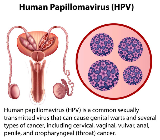 Papillomavirus humain avec illustration d'explication - Vecteur, image